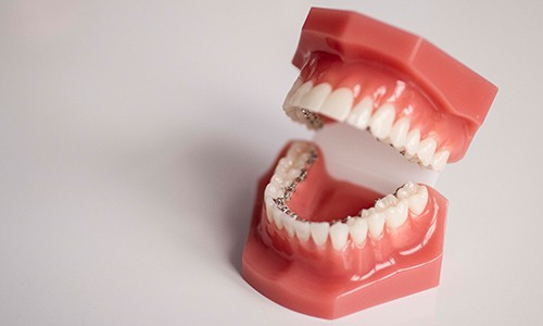 Precio-brackets-linguales