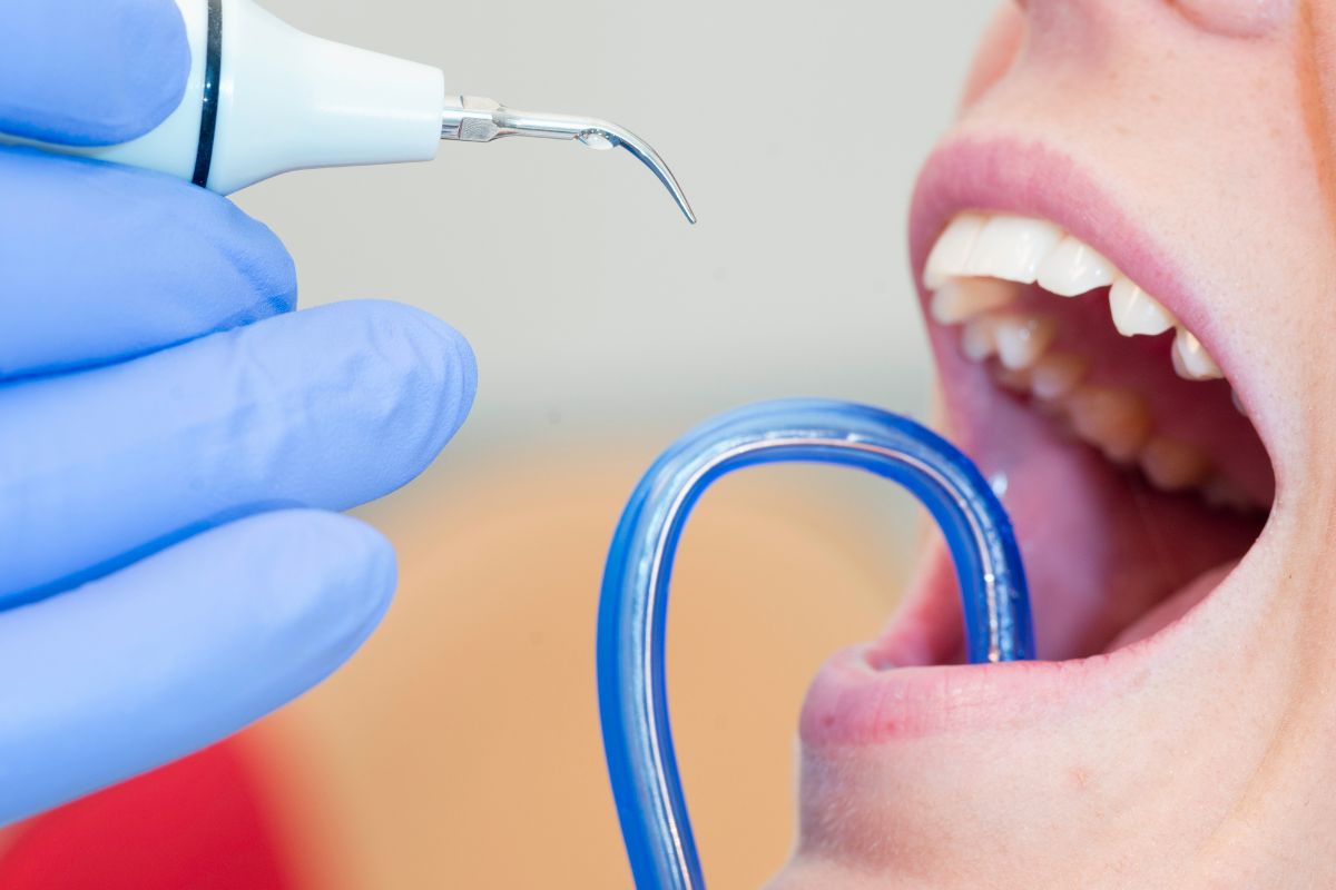limpieza dental profesional